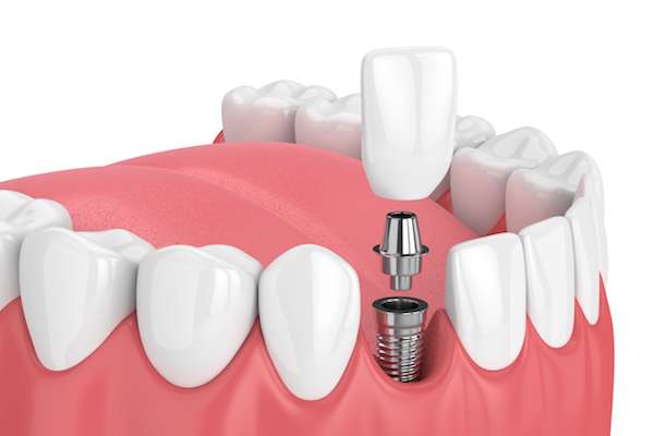 Dental Implants in gwalior