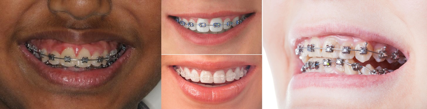 Teeth doctar in gwalior