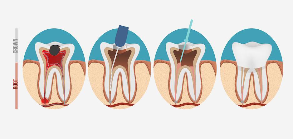 Root Canal Treatment in gwalior 